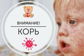 Второй случай заболевания корью выявлен в Красноярском крае